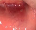 Белое пятно на слизистой нижней губы фото 2
