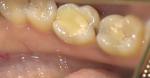 Ноющие боли зуба фото 4