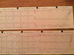 Расшифровка ЭКГ после инфаркта миокарда фото 2