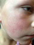 Сыпь у ребёнка на щеках и ушах фото 1