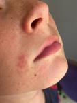 Красная сыпь на лице (возле носа и на подбородке) фото 1