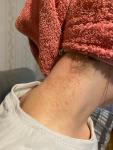 Сыпь на шее, аллергия фото 1