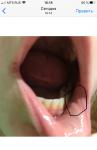 Шишка внутри возле нижней губы фото 1