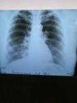 Воспаление лёгких фото 1