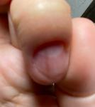 Темно-коричневая продольная полоска на ногте указательного пальца правой руки фото 1