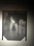 Болит леченный зуб фото 1