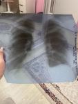 Рентген легких помогите расшифровывать пожалуйста фото 5