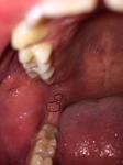 Белые образования слизистой на месте зуба фото 1