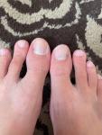 Чёрные симметричные пятна на больших пальцах ног фото 2