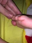 Сыпь на пальце у ребенка фото 1
