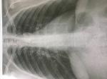 Рентген снимки легких в 2х проекциях фото 1