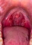 Ощущение инородного тела в горле, странная форма миндалины фото 1