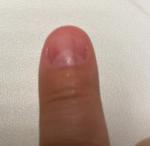 Темно-коричневая продольная полоска на ногте указательного пальца правой руки фото 3