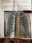 Рентген легких и кашель долгий фото 1