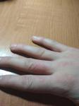 Покраснение и шелушение кожи на пальце руки фото 2