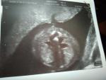 20 недель беремености на узи пиелоэктазия у плода с 2х сторон фото 1