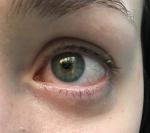 Красные сосуды в глазах и напряжение (8 месяцев) фото 1