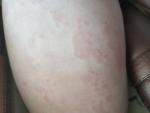Аллергия, возможно крапивница фото 1