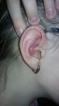 Опухоль уха у ребёнка фото 2