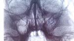 Рентген придаточных пазух носа фото 1