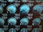 Расшифровать МРТ головного мозга фото 2