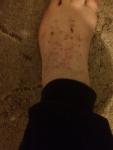 Болезнь на ногах(сыпь) фото 1