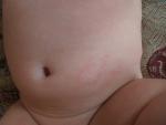 Разные пятна на теле у грудного ребенка фото 2
