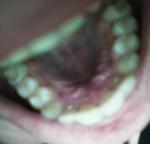 Нарост около верхнего зуба фото 2