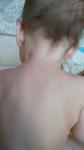 Высыпания на шее и плечах у ребенка фото 2