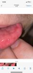 Покраснение во рту без диагноза фото 3