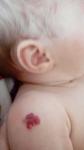 Пятно на плече у ребенка 2-х месяцев фото 1
