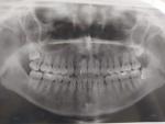 Ретинированный зуб мудрости на верхней челюсти фото 1