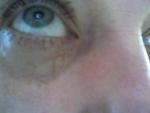 Аллергия на глазах фото 2