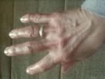 Разрастание суставов на пальцах рук после физической нагрузки фото 2