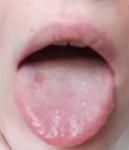 Боль языка, пятно на щеке, боюсь онкологии фото 1