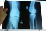 Боли в колене после удаления варикоза фото 3
