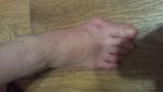 Воспаление пальца на ноге фото 2