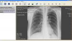 Рентгенологи не могут определить, есть ли пневмония фото 1