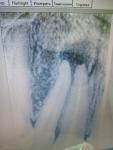 На нажатии корня переднего зуба боль фото 1