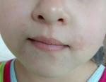Красная сыпь вокруг рта ребенка фото 3
