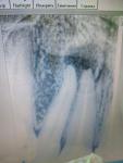 На нажатии корня переднего зуба боль фото 2