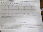 Аритмия (частые паузы в работе сердца) фото 1