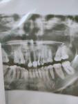 На нажатии корня переднего зуба боль фото 3
