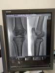 Болит колено после артроскопии фото 3