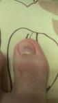 Пятно под ногтем на большем пальце ноги фото 1