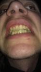 Потемнели переднии зубы фото 2