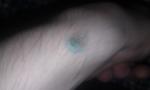 Кругообразная болячка на руке фото 2
