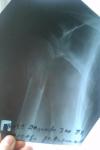 Перелом плечевой кости фото 1