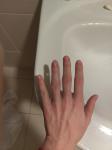 Боли и увеличение суставов фалангов пальцев фото 4