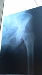 Перелом сидалищной кости фото 1
